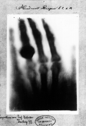 Photographie de la première radiographie de l’histoire prise le 22 décembre 1895.